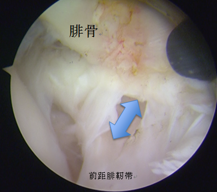 鏡視下靭帯修復術（鏡視下Brostrom法）