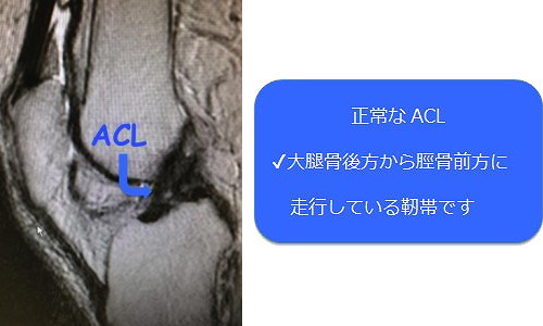 ACL1