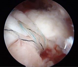 腱板断裂の治療3